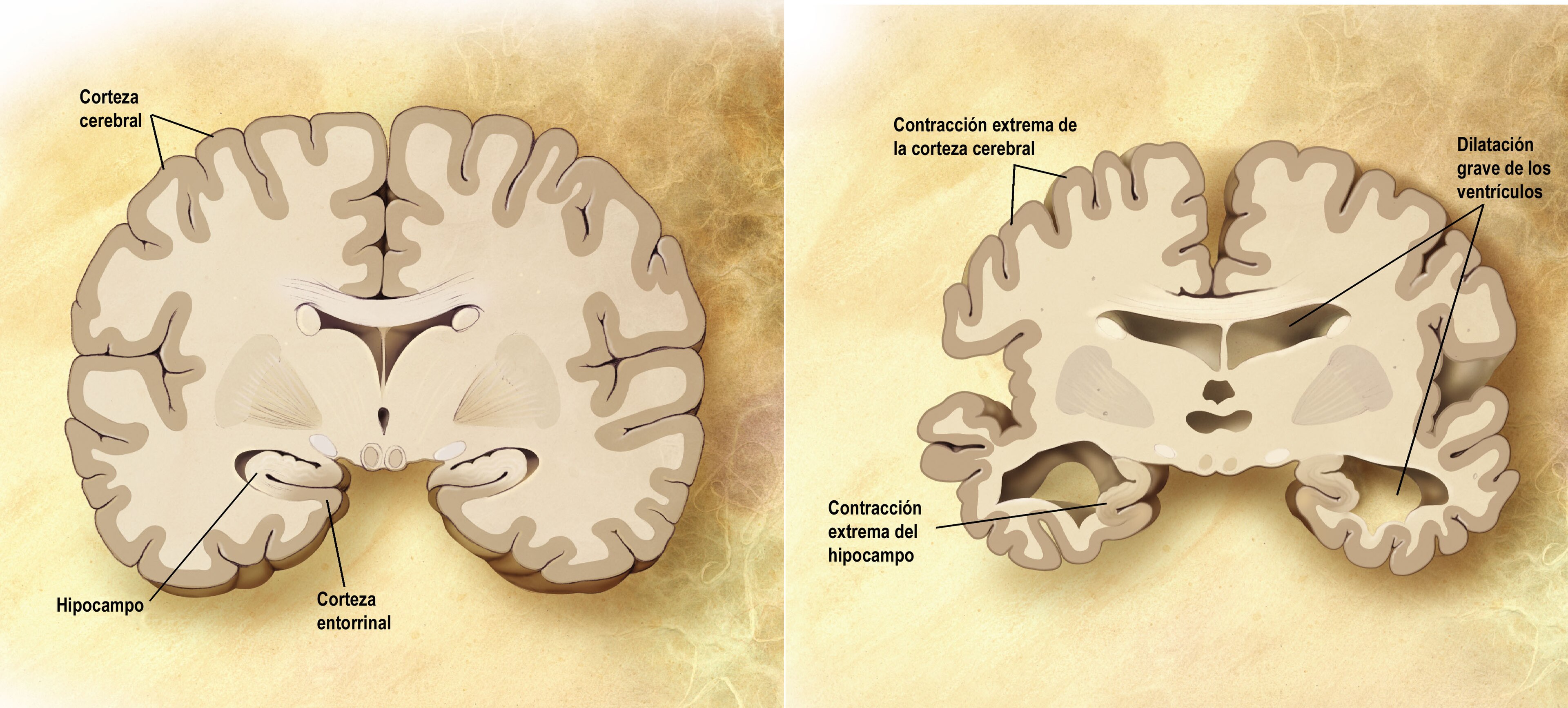 Wikipedia / Enfermedad de Alzheimer (es)